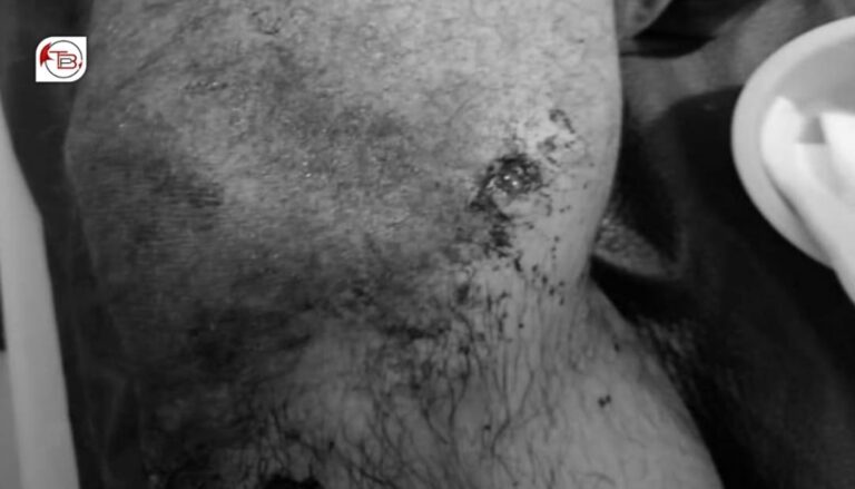 کیچ: مارٹر گولہ ءِ لگگ ءَ یک مردمےزدگ